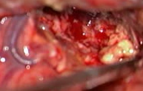 5-ALA reichert sich in Glioblastomen an und führt zur Akkumulation von Protoporphyrin IX.