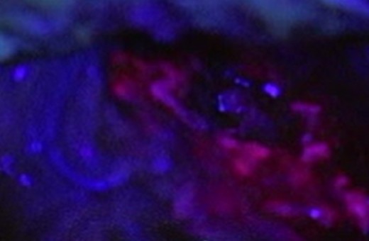 Die daraus resultierende Fluoreszenz des Tumors in der Farbe Rosa ermöglicht eine genauere intraoperative Differenzierung des Tumors vom angrenzenden Hirngewebe. Dies trägt zu einem höheren Resektionsgrad bei und verbessert somit die Prognose.